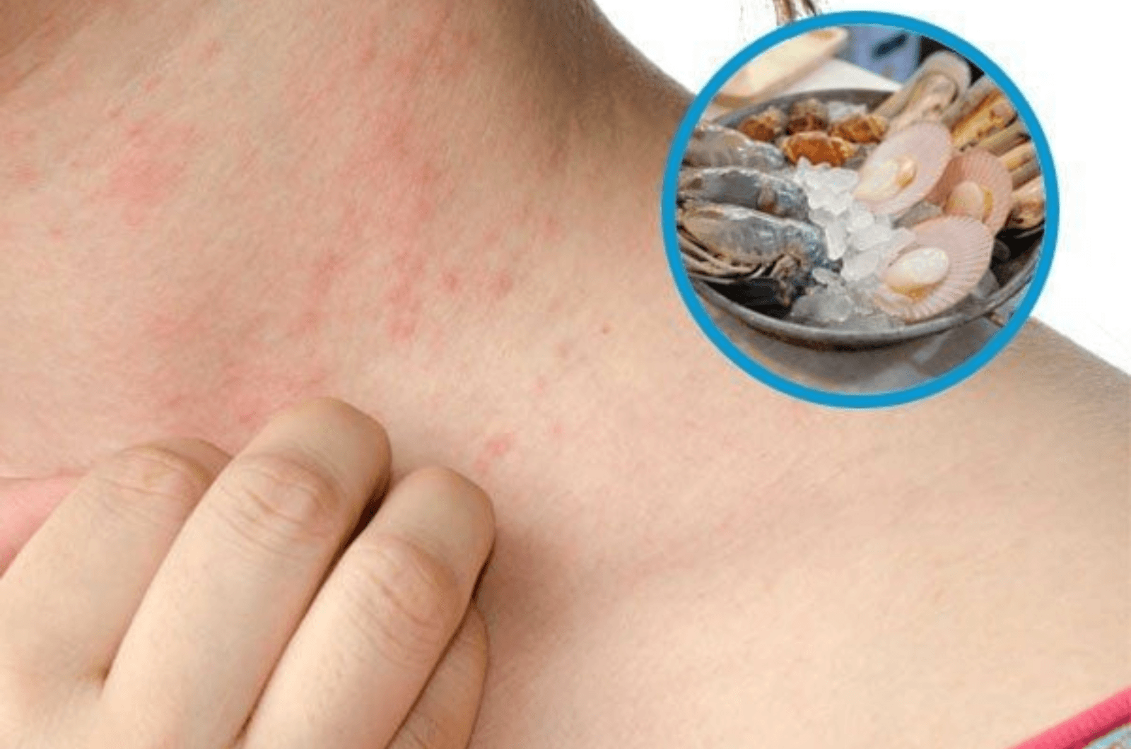Cách xử lý khi bị dị ứng do ăn hải sản