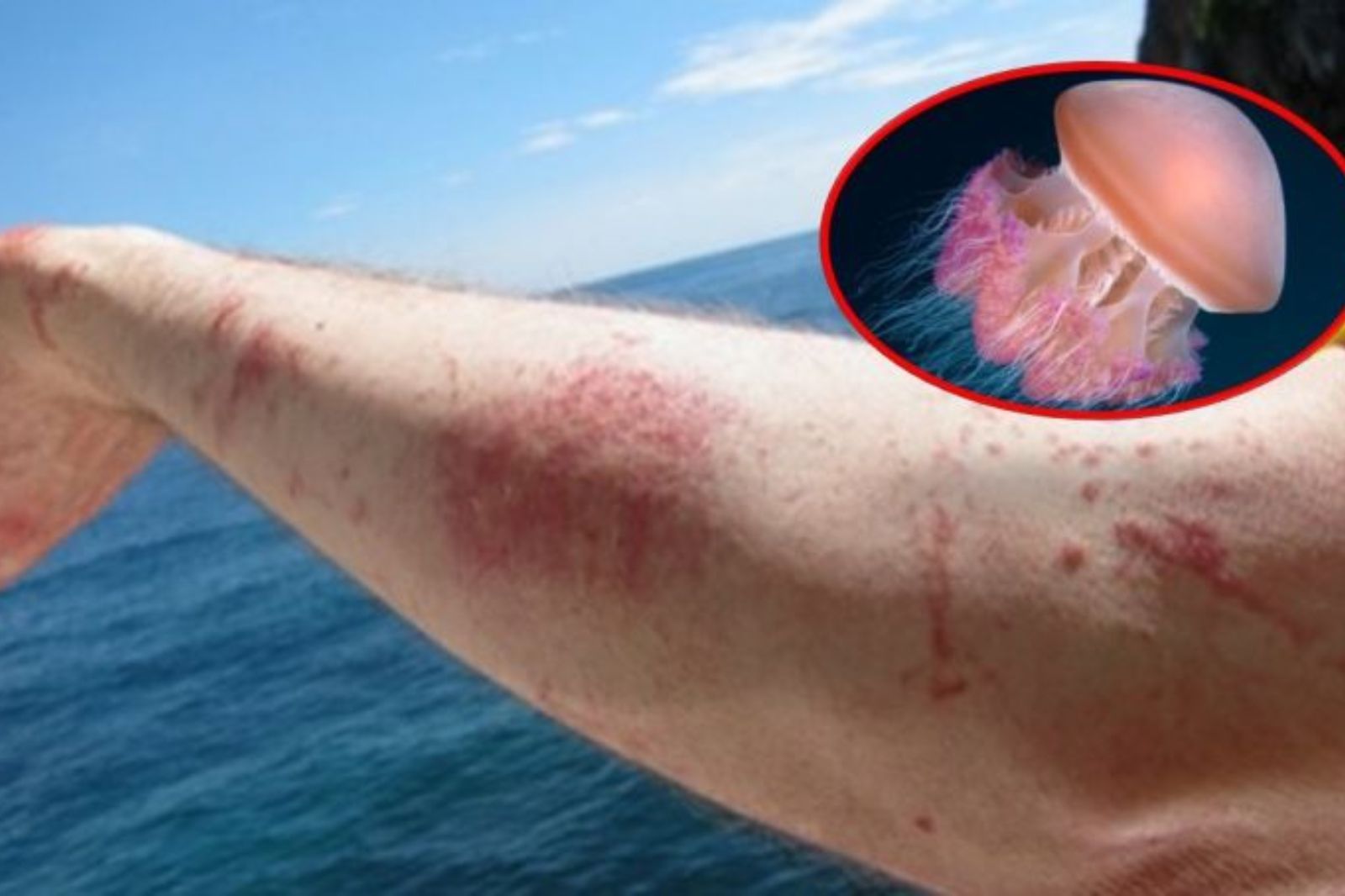 Dị ứng do sứa đốt