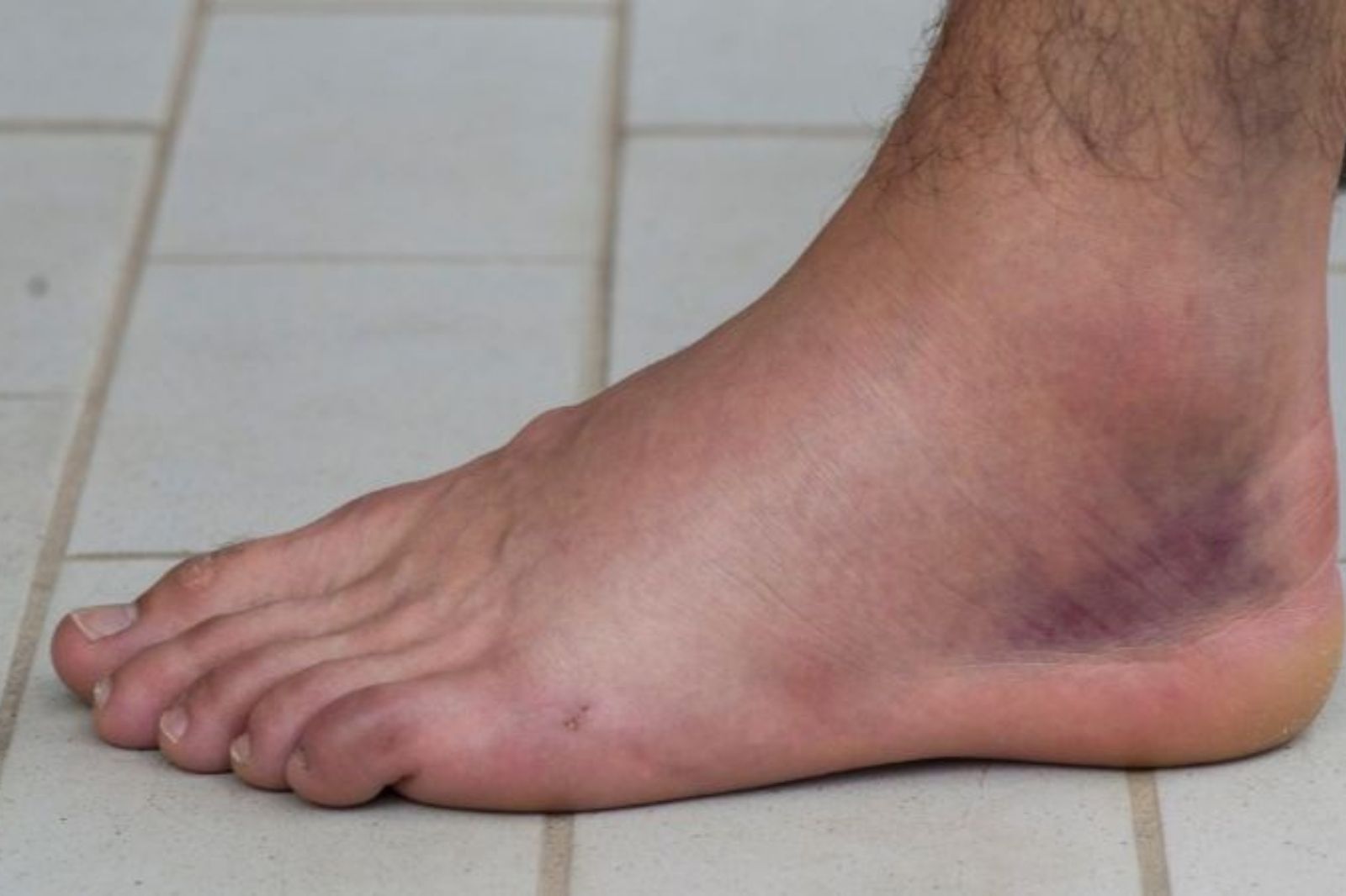 Biểu hiện của trật khớp 